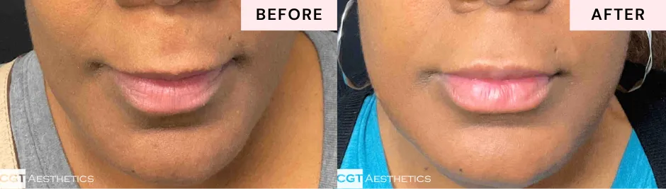 Before and after lip filler showing improved lip definition and smoother-looking lip contours
