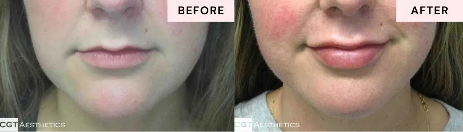 Before and after lip filler showing natural-looking lip volume and definition at CGT Aesthetics