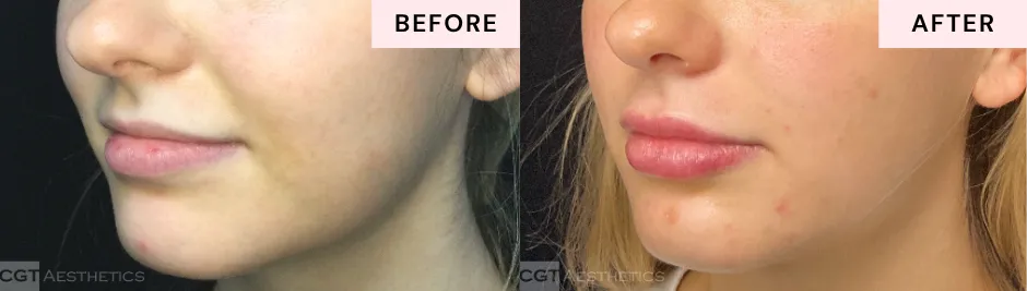 Side-profile before and after lip filler showing enhanced lip projection and facial balance