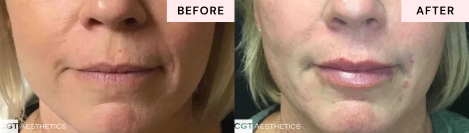 Before and after lip filler showing subtle volume enhancement and smoother lip contours