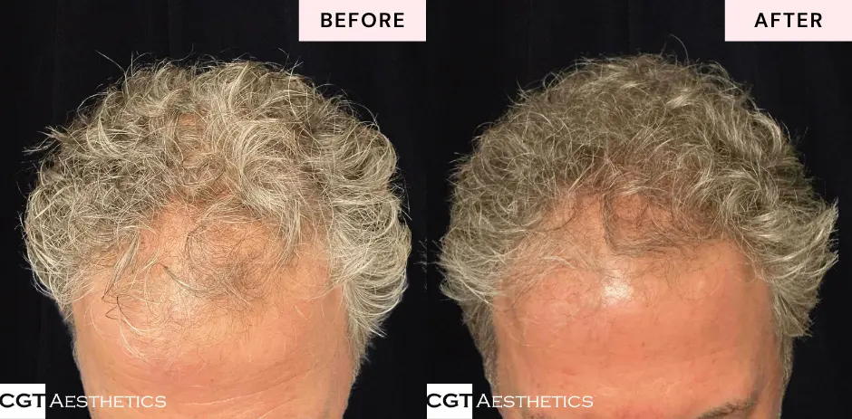 Alma TED hair restoration before and after results showing fuller looking hair at CGT Aesthetics in Evergreen Park and Westmont IL