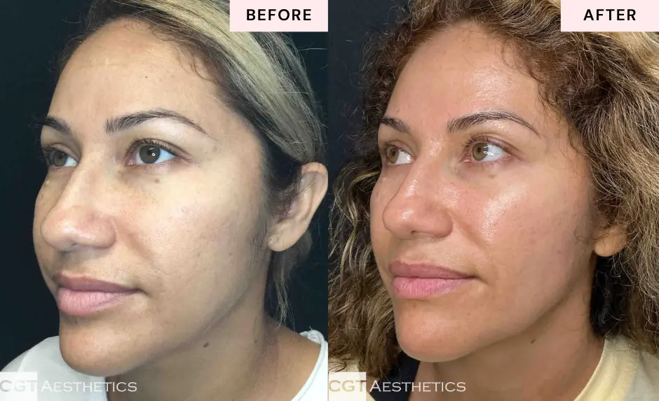 Skincare Membership before and after at CGT Aesthetics showing facial skin from an angled view.