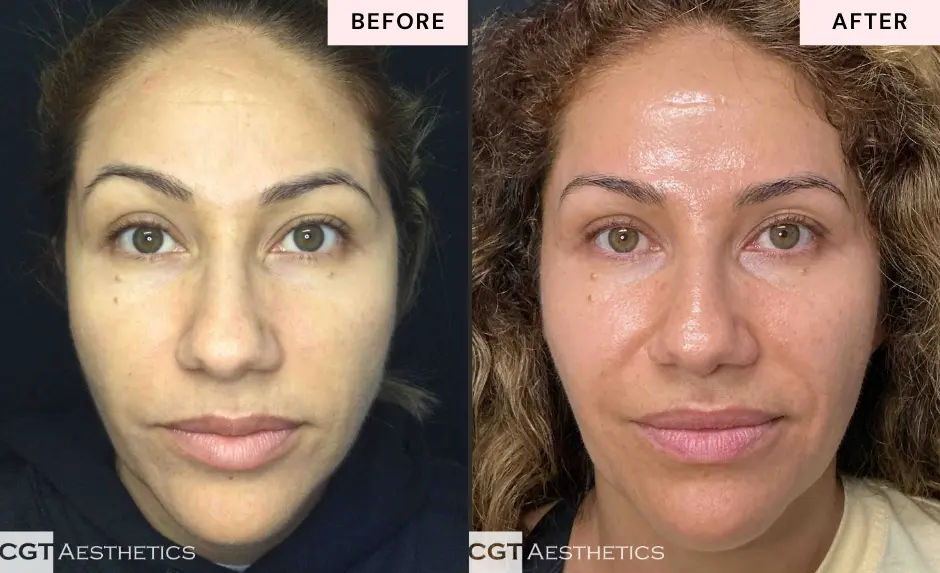 Skincare Membership before and after at CGT Aesthetics showing facial skin from the front view.
