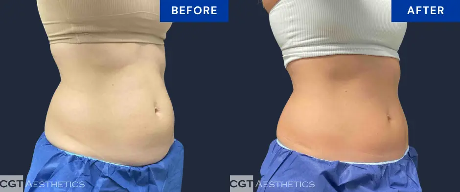 CoolSculpting Elite abdomen before and after result at CGT Aesthetics, angled view