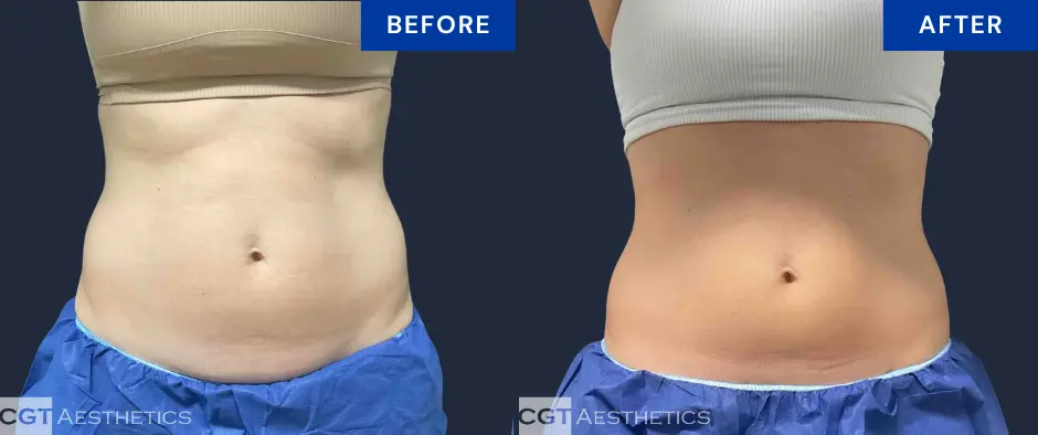 CoolSculpting Elite abdomen before and after result at CGT Aesthetics, front view
