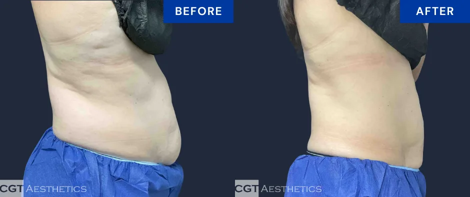 CoolSculpting Elite abdomen before and after result at CGT Aesthetics, side view