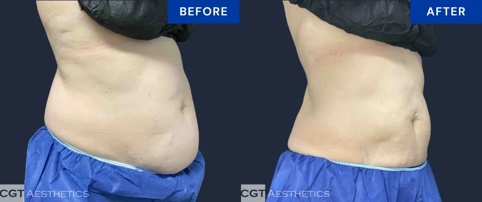 CoolSculpting Elite abdomen before and after result at CGT Aesthetics, angled view