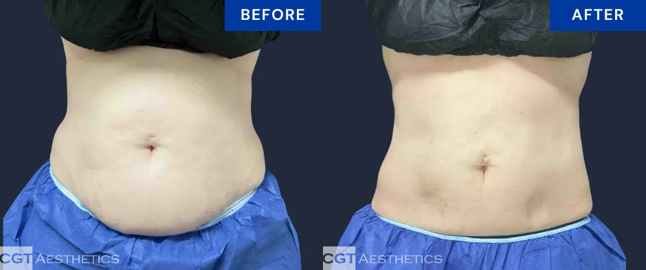 CoolSculpting Elite abdomen before and after result at CGT Aesthetics, front view