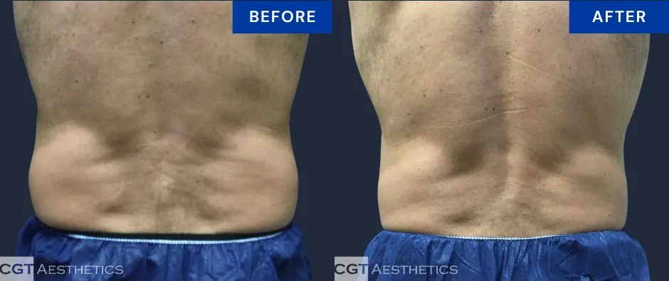 CoolSculpting Elite abdomen and flanks before and after results shown from the back at CGT Aesthetics