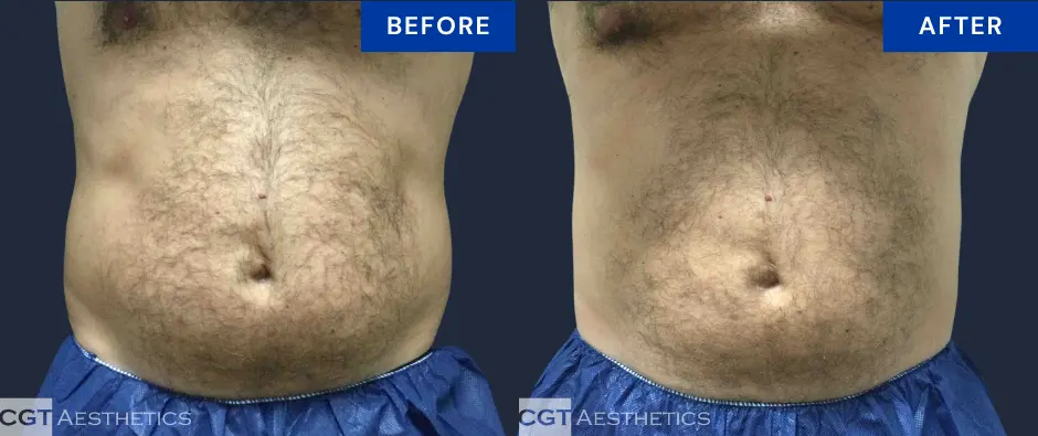 CoolSculpting Elite abdomen and flanks before and after body contouring results at CGT Aesthetics