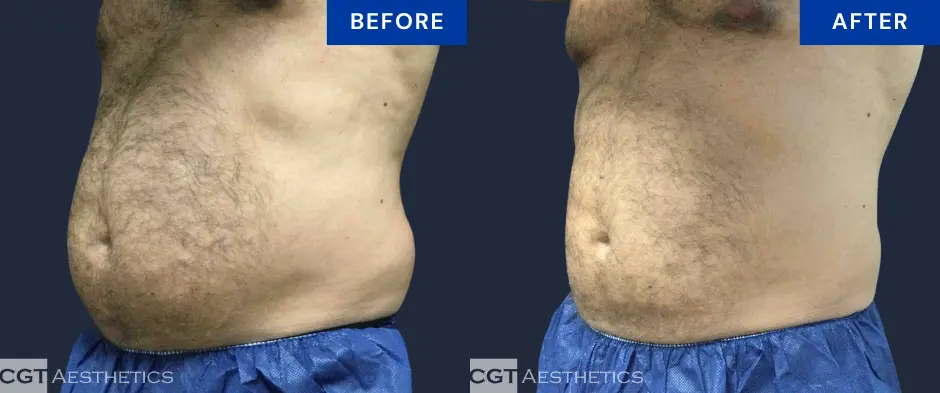 CoolSculpting Elite abdomen and flanks before and after body contouring results at CGT Aesthetics