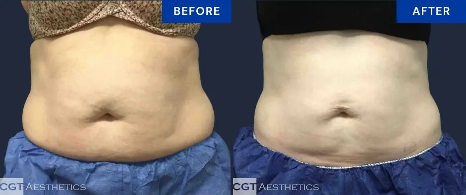 CoolSculpting Elite abdomen and flanks before and after results at CGT Aesthetics for non-surgical body contouring