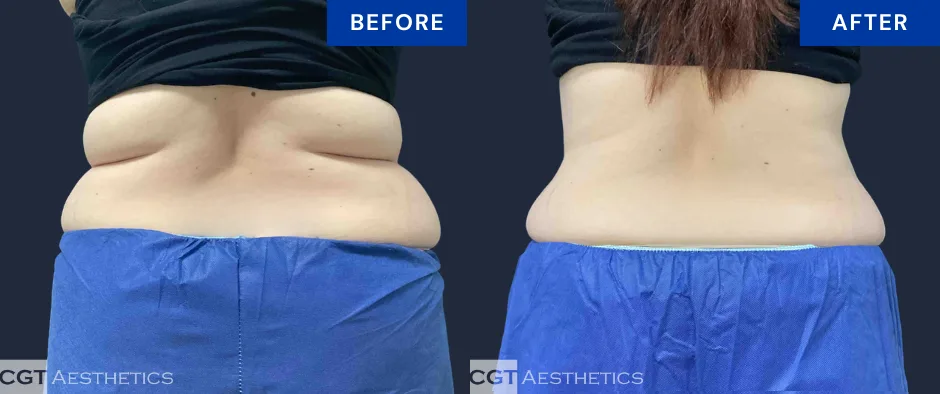 CoolSculpting Elite back fat and flanks before and after result at CGT Aesthetics