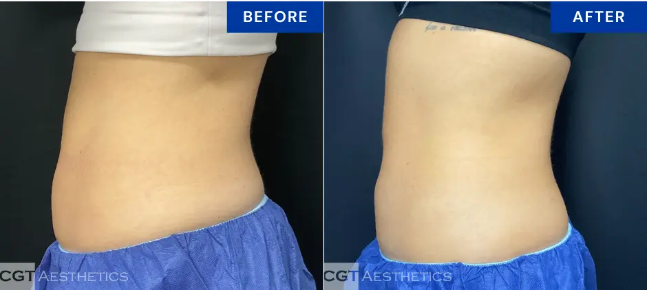 CoolTone abdomen before and after results at CGT Aesthetics in Evergreen Park and Westmont, IL