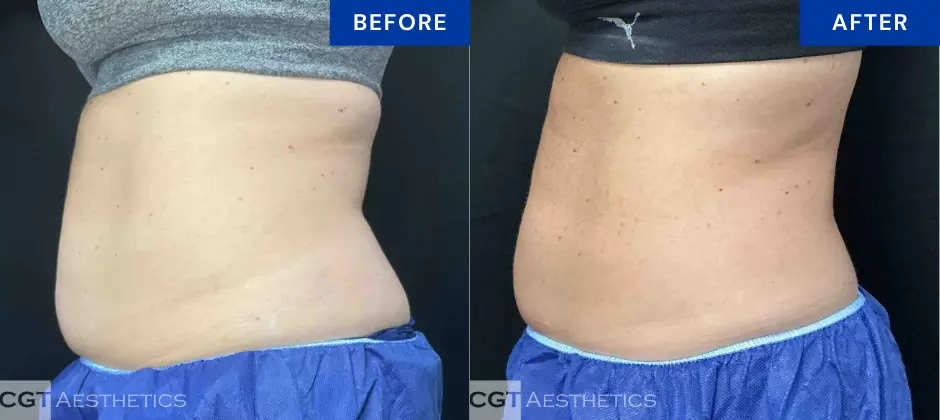 CoolTone abdomen before and after results at CGT Aesthetics in Evergreen Park and Westmont, IL