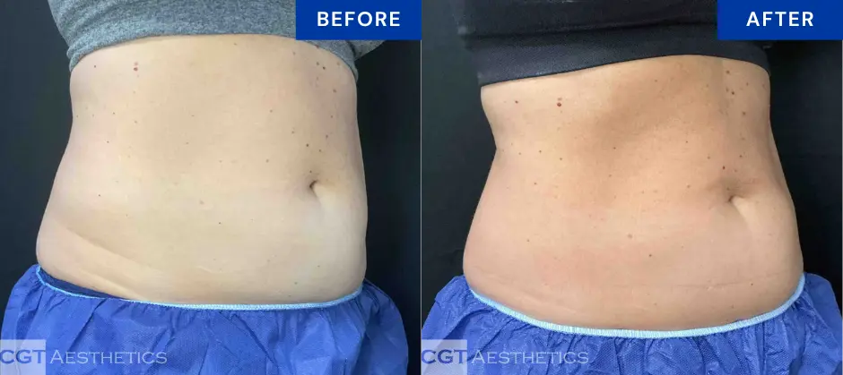 CoolTone abdomen before and after results at CGT Aesthetics in Evergreen Park and Westmont, IL