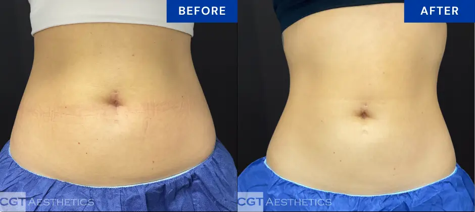 CoolTone abdomen before and after results at CGT Aesthetics in Evergreen Park and Westmont, IL
