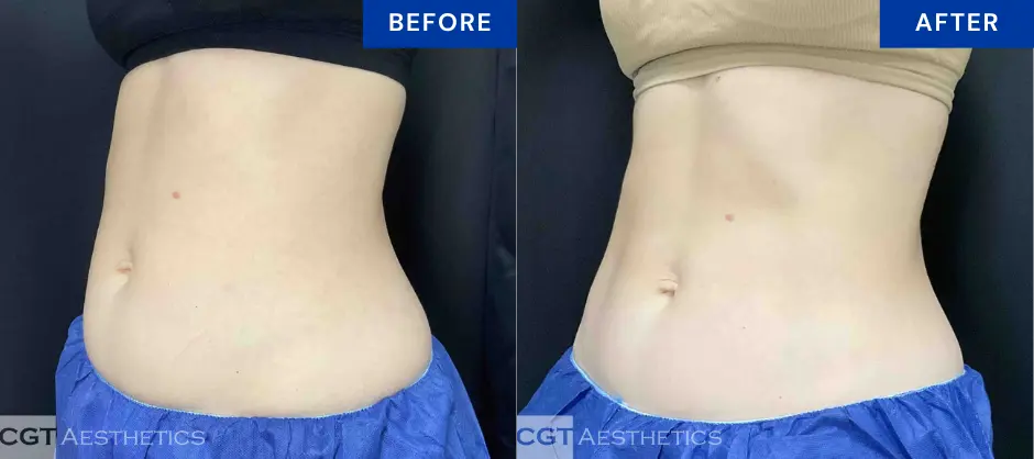 CoolTone abdomen before and after results at CGT Aesthetics in Evergreen Park and Westmont, IL