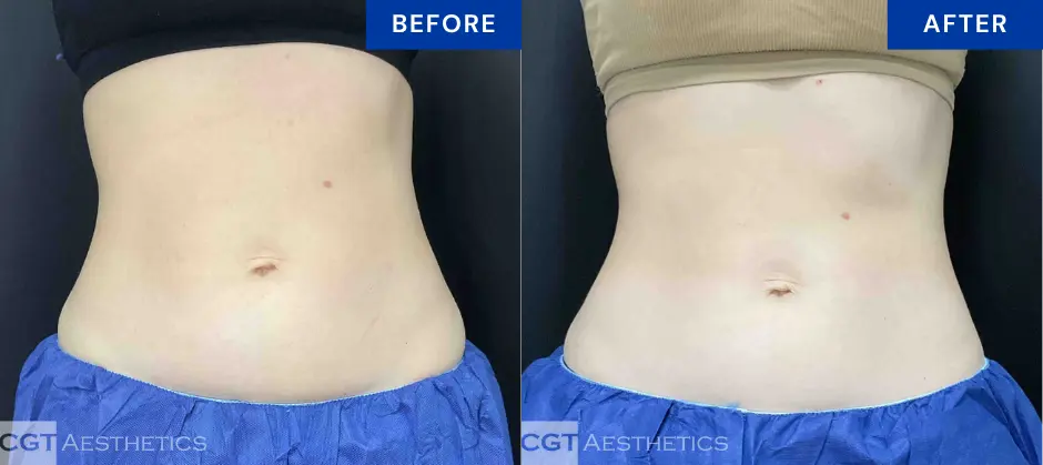 CoolTone abdomen before and after results at CGT Aesthetics in Evergreen Park and Westmont, IL