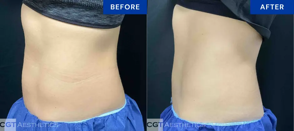 CoolTone abdomen before and after results at CGT Aesthetics in Evergreen Park and Westmont, IL