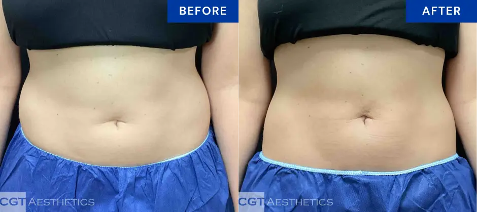CoolTone abdomen before and after results at CGT Aesthetics in Evergreen Park and Westmont, IL