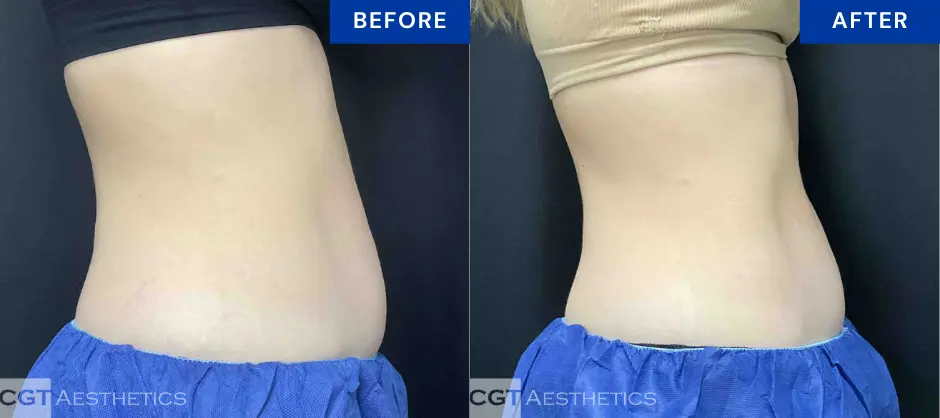 CoolTone abdomen before and after results at CGT Aesthetics in Evergreen Park and Westmont, IL