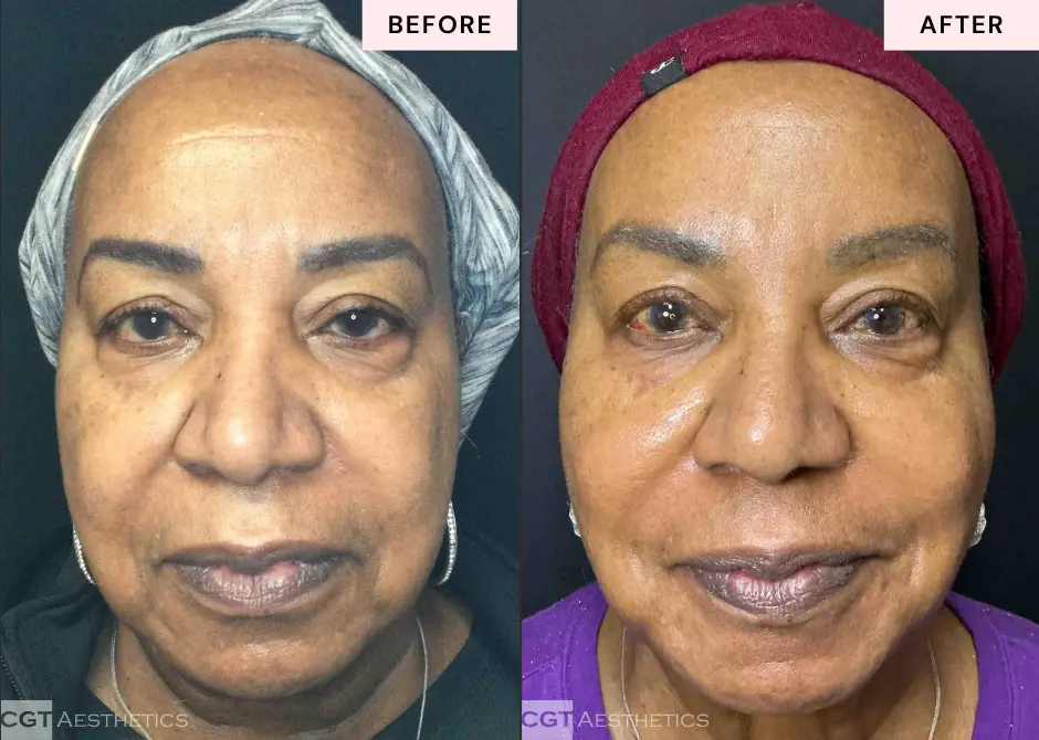 LaseMD Ultra Laser before and after front view showing brighter smoother looking skin at CGT Aesthetics in Evergreen Park and Westmont IL