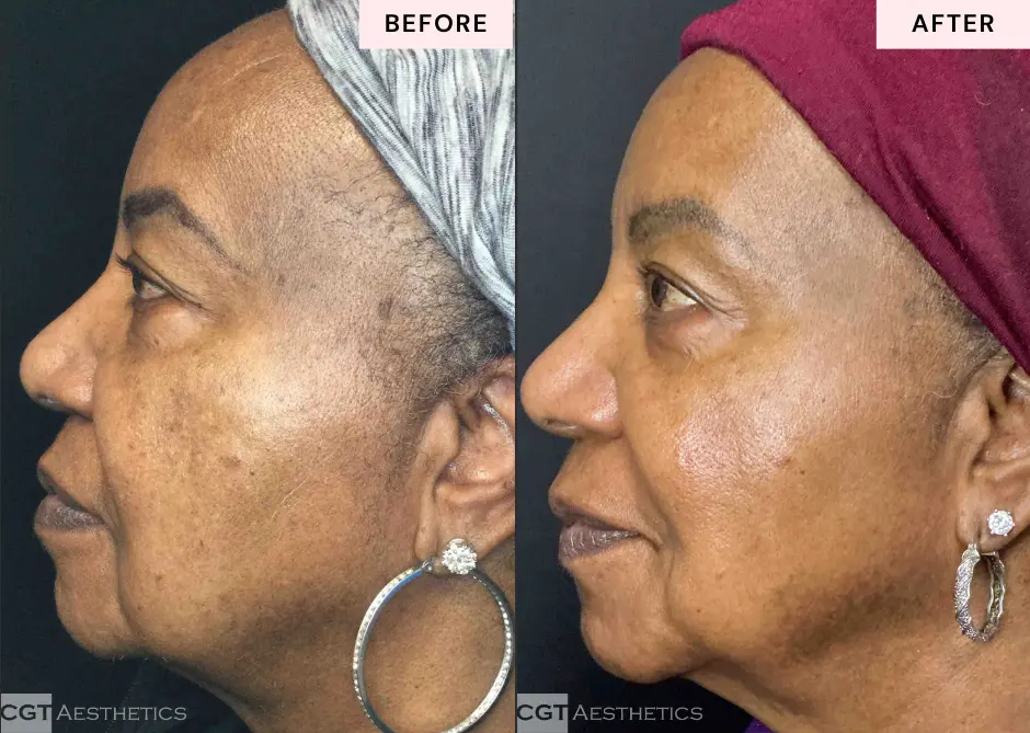 LaseMD Ultra Laser before and after side view showing improved looking skin tone and texture at CGT Aesthetics in Evergreen Park and Westmont IL