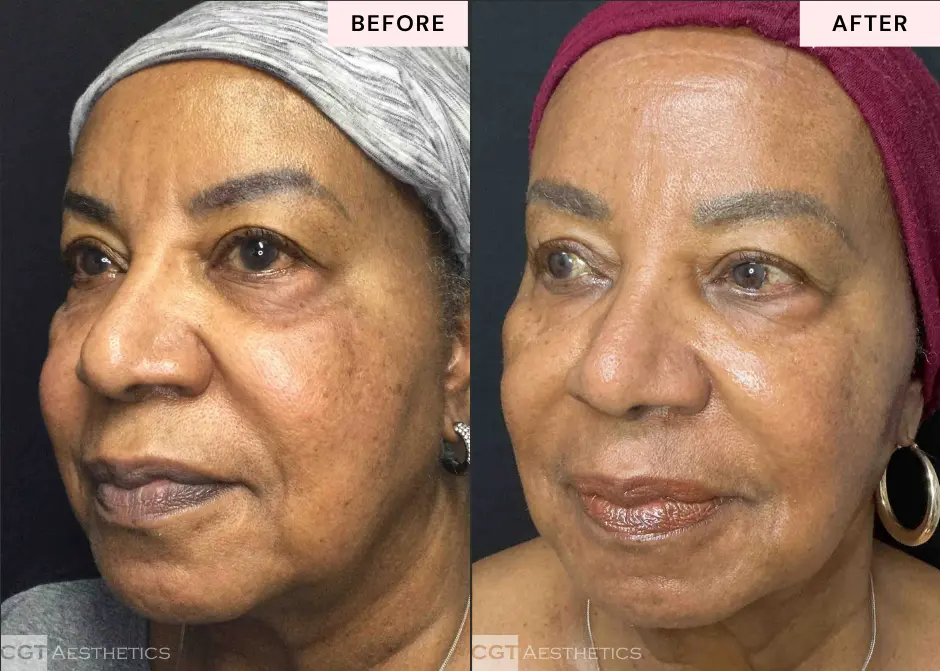 LaseMD Ultra Laser before and after results showing skin rejuvenation and a more even looking complexion at CGT Aesthetics in Evergreen Park and Westmont IL