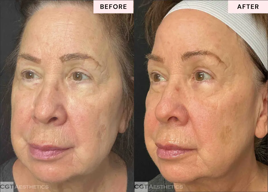 XERF before and after facial skin tightening results showing refreshed firmer looking skin at CGT Aesthetics in Evergreen Park and Westmont IL