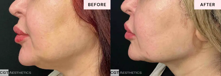 XERF facial skin tightening before and after results showing natural looking contour improvement at CGT Aesthetics
