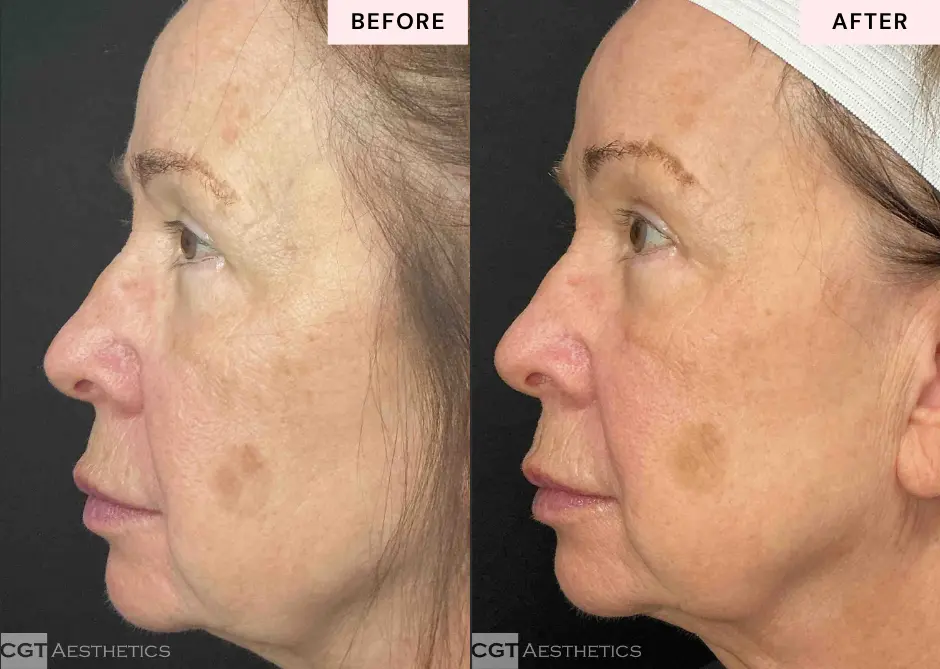 XERF Structural Skin Tightening before and after side view showing improved looking facial firmness and jawline definition at CGT Aesthetics