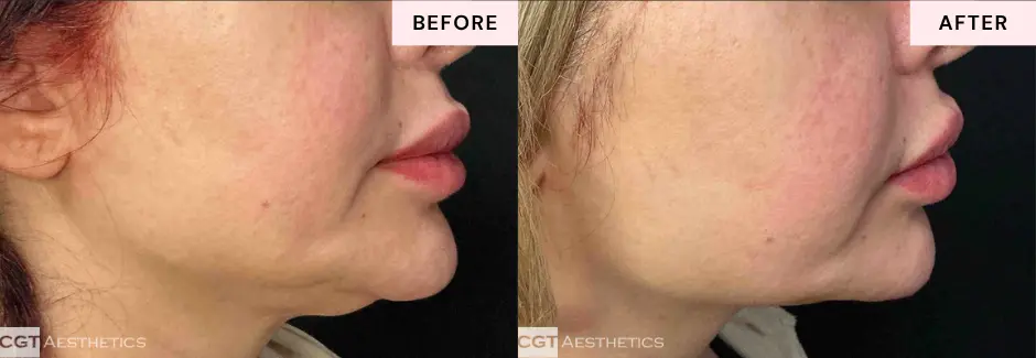 XERF facial skin tightening before and after results showing natural looking contour improvement at CGT Aesthetics
