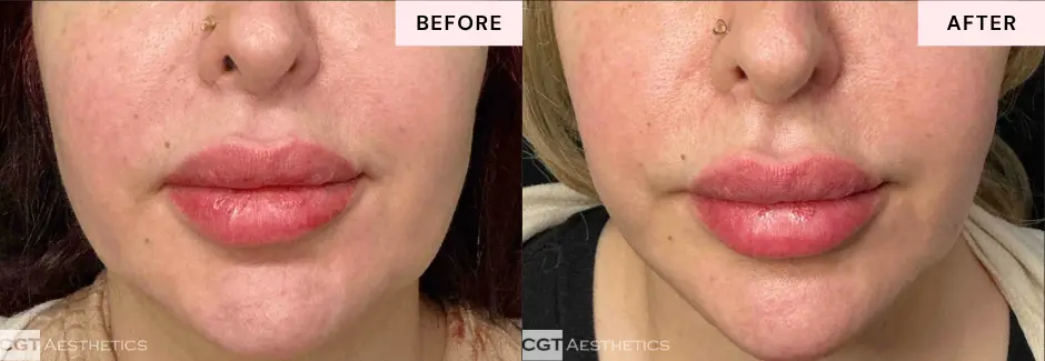 XERF Structural Skin Tightening before and after results showing firmer smoother looking skin at CGT Aesthetics