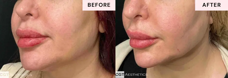 XERF facial skin tightening before and after results showing natural looking contour improvement at CGT Aesthetics