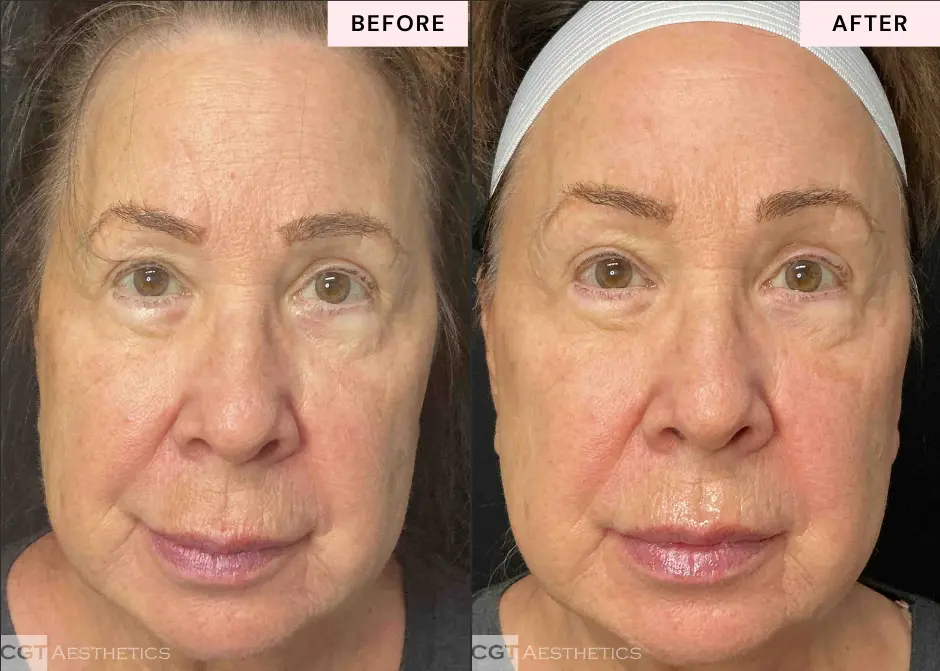 XERF Structural Skin Tightening before and after front view showing firmer smoother looking skin at CGT Aesthetics in Evergreen Park and Westmont IL