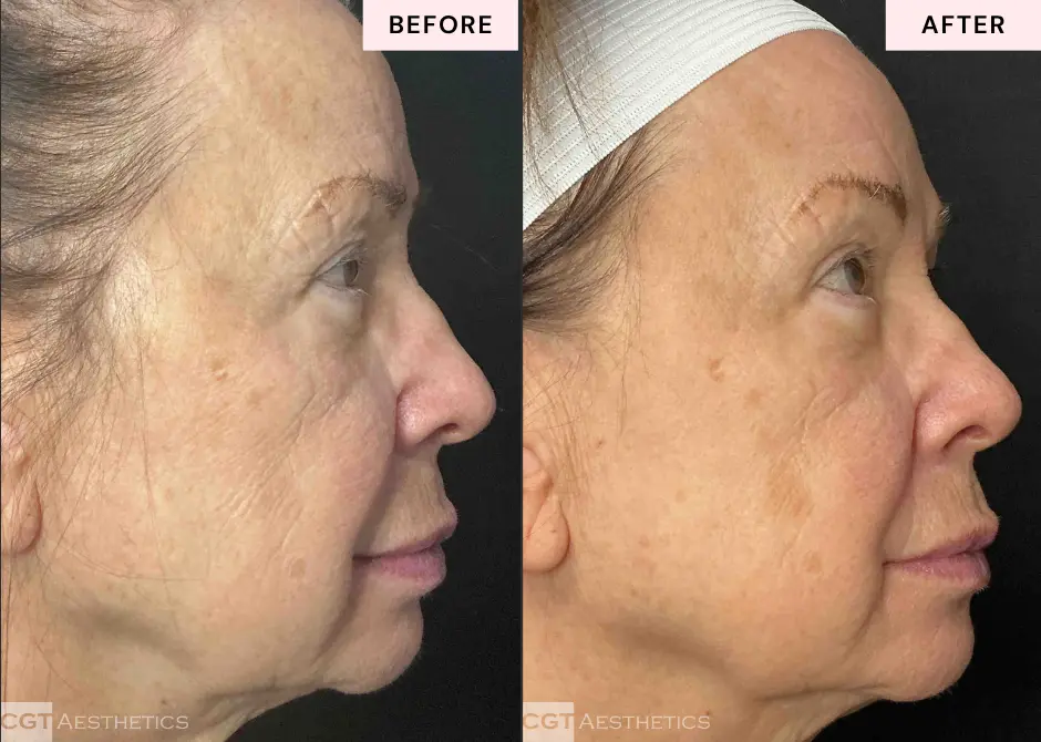 XERF skin tightening before and after profile view showing smoother looking skin and facial contour improvement at CGT Aesthetics
