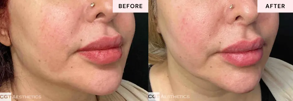 XERF facial skin tightening before and after results showing natural looking contour improvement at CGT Aesthetics