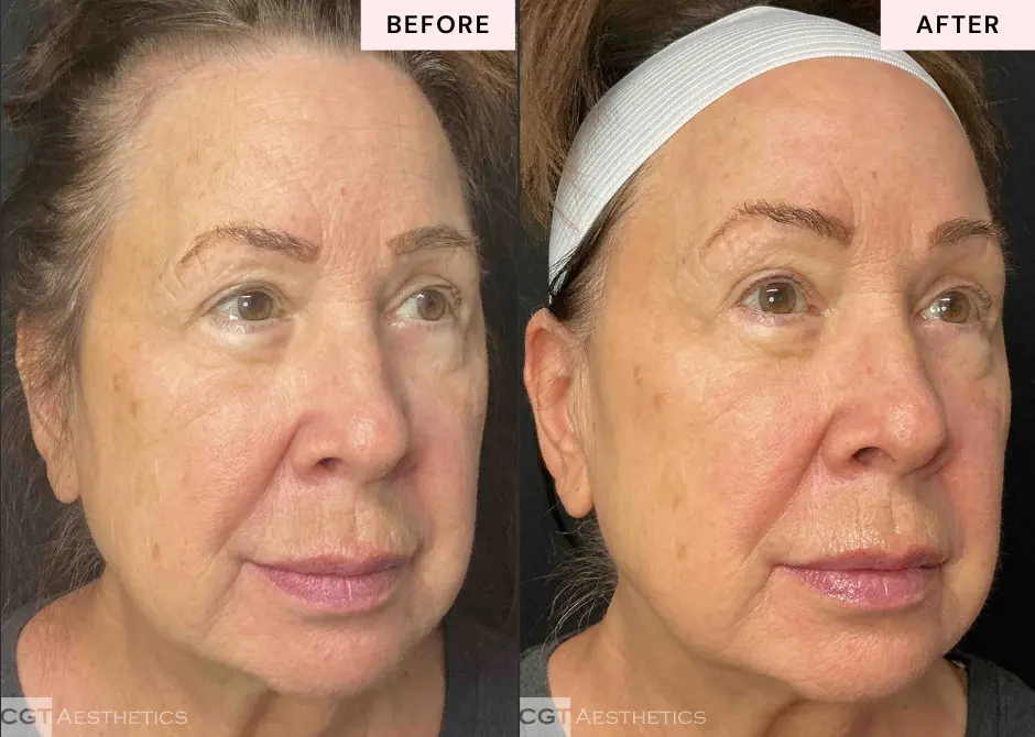 XERF skin tightening before and after profile view showing smoother looking skin and facial contour improvement at CGT Aesthetics