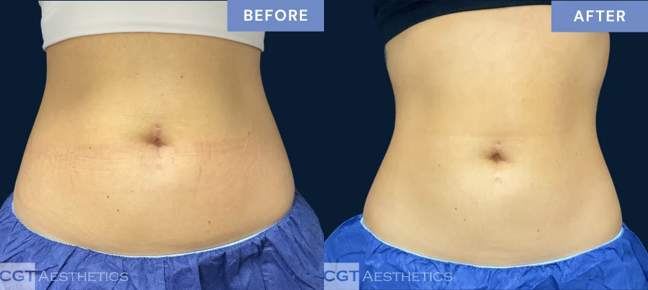 CoolTone abdomen before and after results from a real CGT Aesthetics patient.