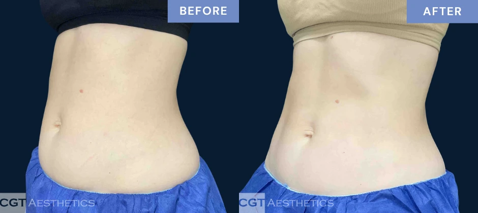 CoolTone abdomen before and after results from a real CGT Aesthetics patient.