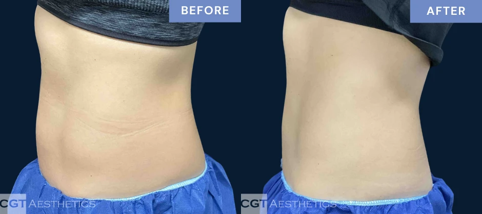 CoolTone abdomen before and after results from a real CGT Aesthetics patient.