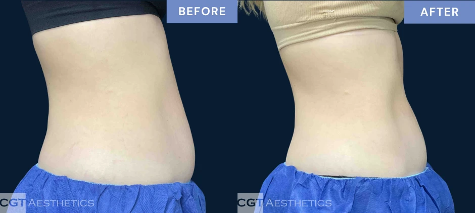 CoolTone abdomen before and after results from a real CGT Aesthetics patient.
