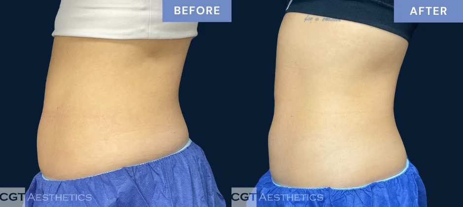 CoolTone abdomen before and after results from a real CGT Aesthetics patient.