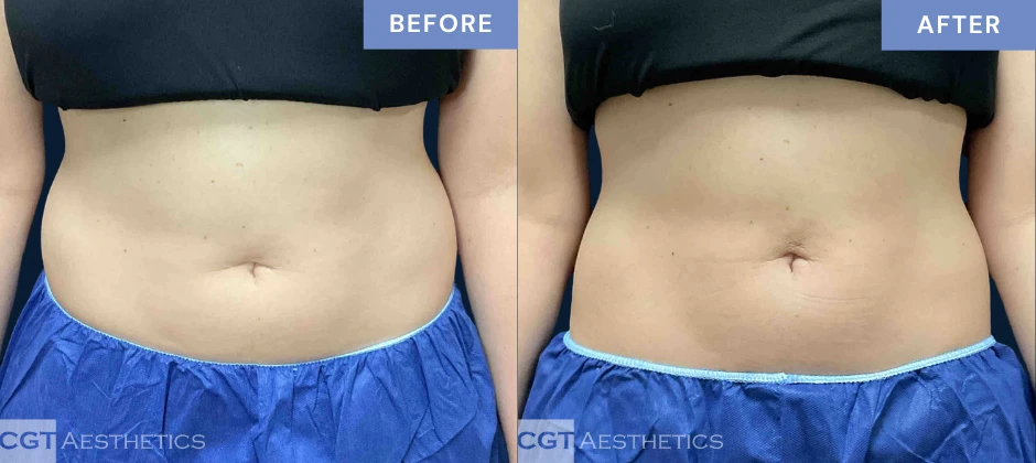 CoolTone abdomen before and after results from a real CGT Aesthetics patient.