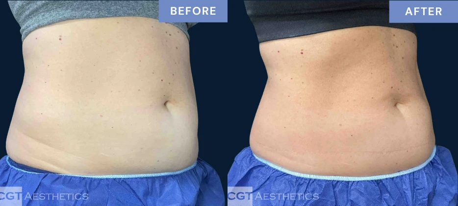 CoolTone abdomen before and after results from a real CGT Aesthetics patient.