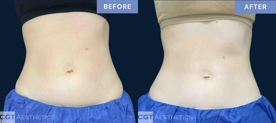 CoolTone abdomen before and after results from a real CGT Aesthetics patient.