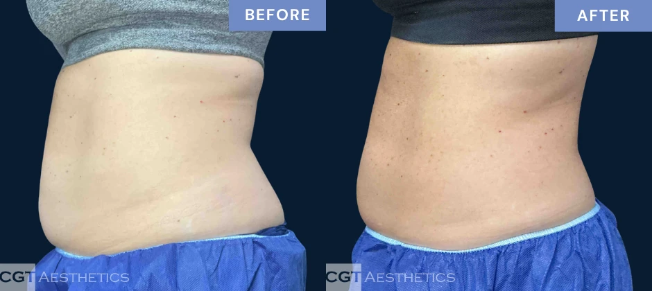 CoolTone abdomen before and after results from a real CGT Aesthetics patient.